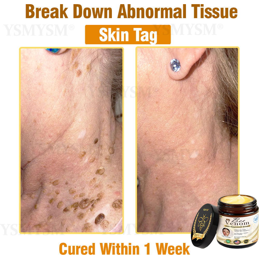 Mayo Clinic Recommended | Official Store | YSMYSM® Full-Body Repair Cream: Anti-Aging, Hydration, Skin Repair, Even Tone, Acne & Dark Spot Treatment, Wart & Mole Removal, Psoriasis Relief