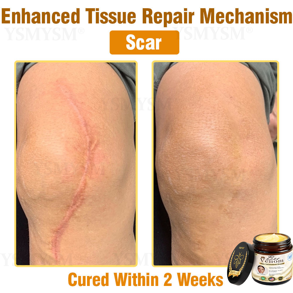 Mayo Clinic Recommended | Official Store | YSMYSM® Full-Body Repair Cream: Anti-Aging, Hydration, Skin Repair, Even Tone, Acne & Dark Spot Treatment, Wart & Mole Removal, Psoriasis Relief
