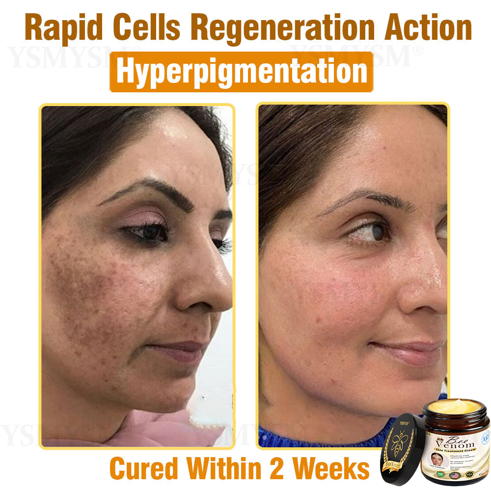 Mayo Clinic Recommended | Official Store | YSMYSM® Full-Body Repair Cream: Anti-Aging, Hydration, Skin Repair, Even Tone, Acne & Dark Spot Treatment, Wart & Mole Removal, Psoriasis Relief
