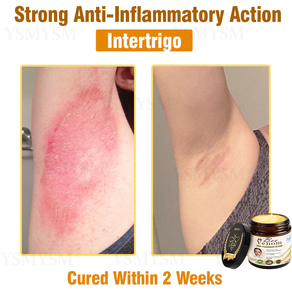 Mayo Clinic Recommended | Official Store | YSMYSM® Full-Body Repair Cream: Anti-Aging, Hydration, Skin Repair, Even Tone, Acne & Dark Spot Treatment, Wart & Mole Removal, Psoriasis Relief