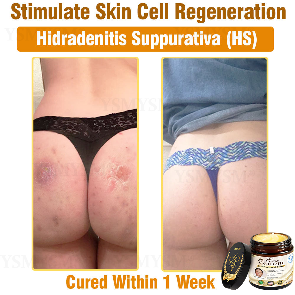 Mayo Clinic Recommended | Official Store | YSMYSM® Full-Body Repair Cream: Anti-Aging, Hydration, Skin Repair, Even Tone, Acne & Dark Spot Treatment, Wart & Mole Removal, Psoriasis Relief